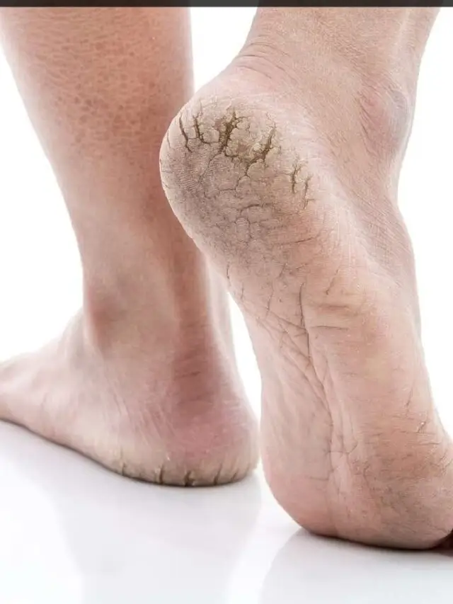 Cracked Heel Treatment