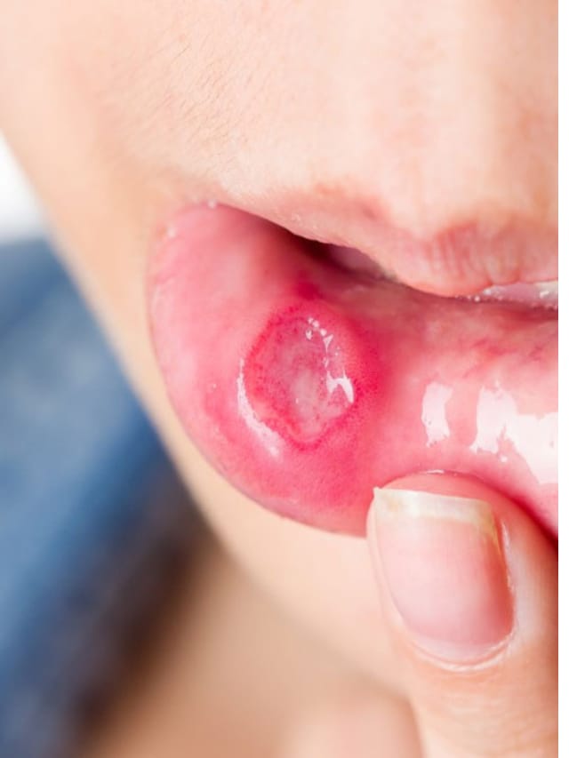 मुंह के छालों